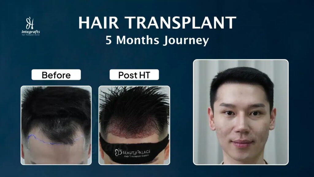 Hair Transplant Journey