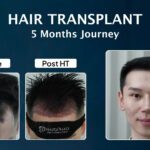Hair Transplant-Heru