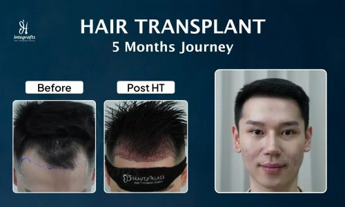 Hair Transplant-Heru